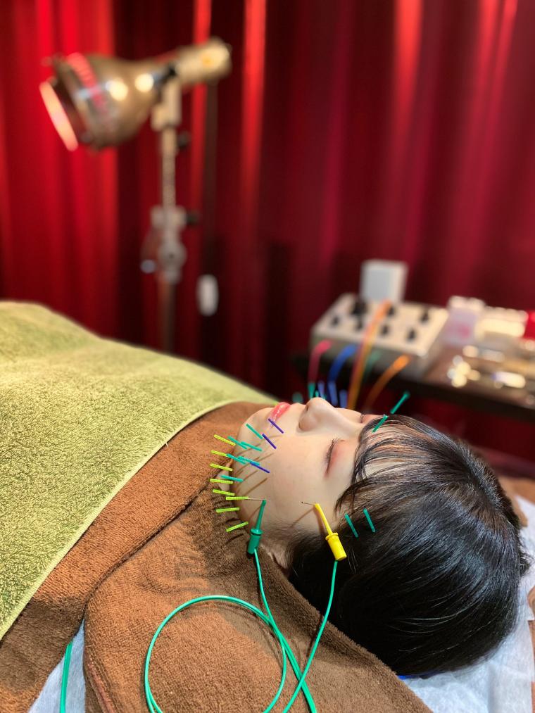 B/CARAT式美容鍼