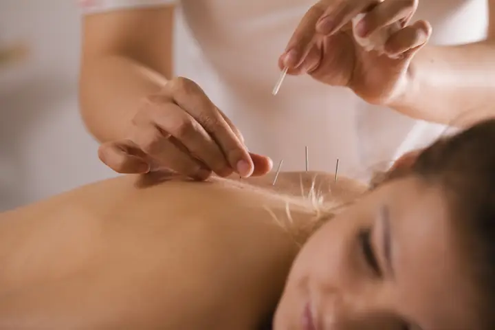 【身体の悩み別】ボディ鍼に期待できる5つの効果